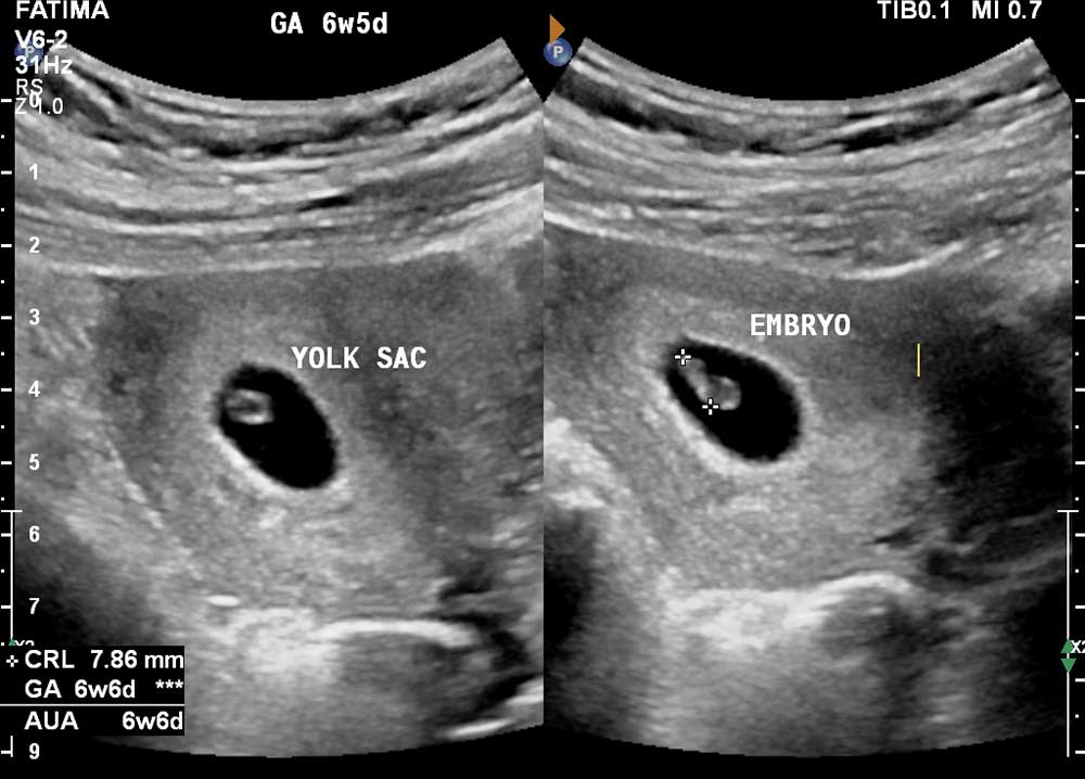 Early Pregnancy Scan